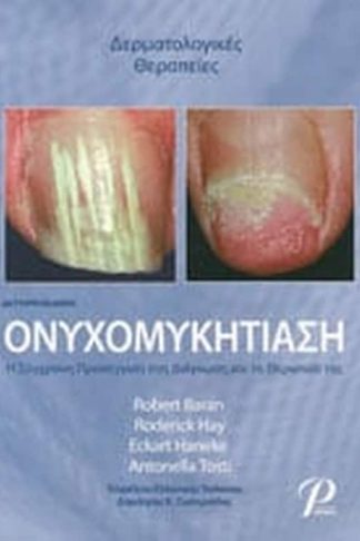 Ονυχομυκητίαση